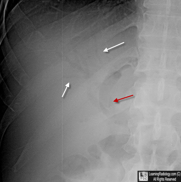 Air in the Biliary System